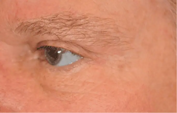 thermage_male-after_2
