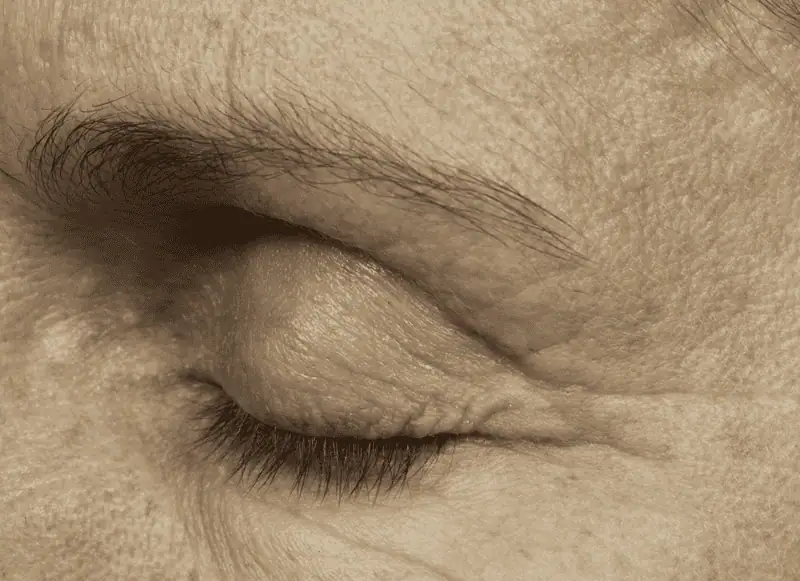 thermage_male-after_3