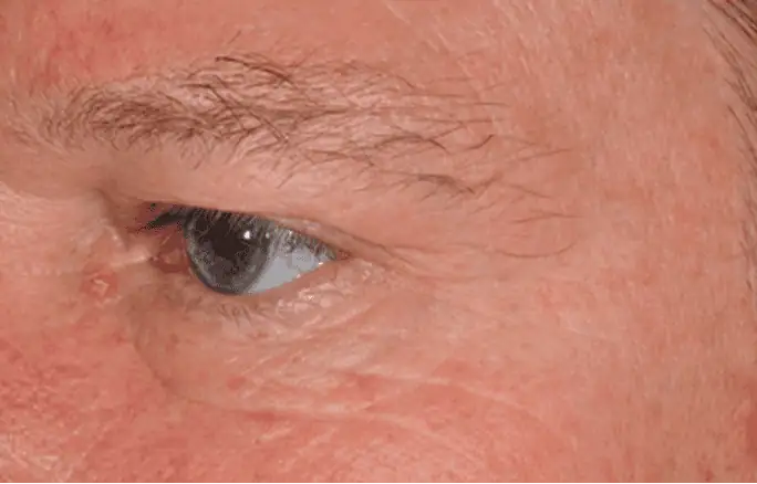 thermage_male-before_2