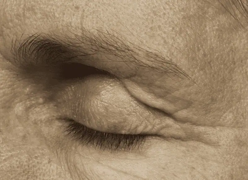 thermage_male-before_3